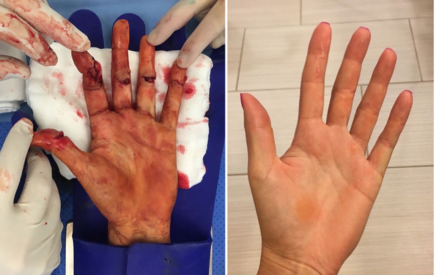 Преди и след: В какво състояние е ръката на Квитова (видео)